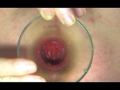 anal proslate insertion pluviometre